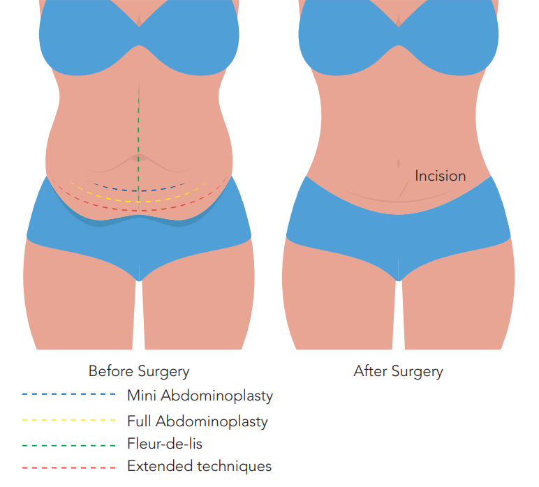 Your Abdominoplasty Journey