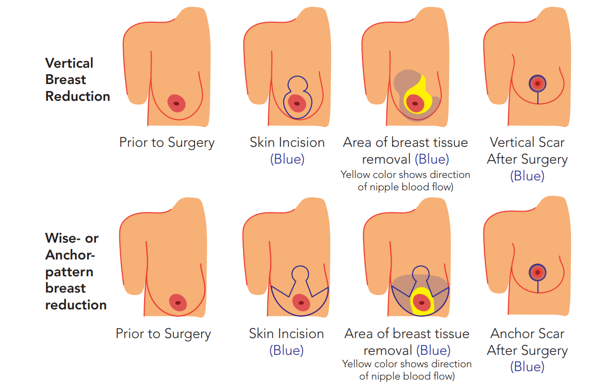 Your Breast Reduction Journey