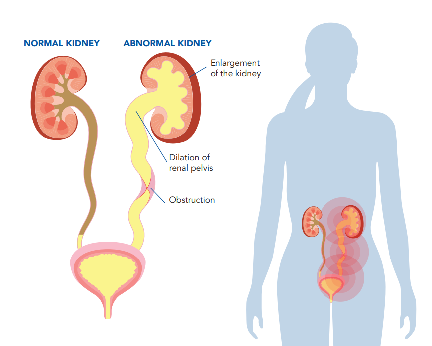 Your DMSA Renal Scan Journey