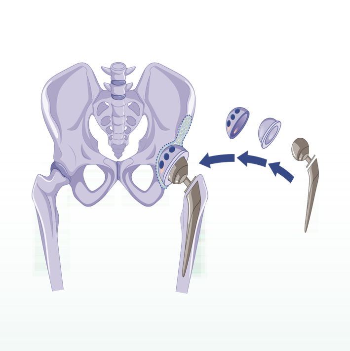 Your Hip Replacement Surgery