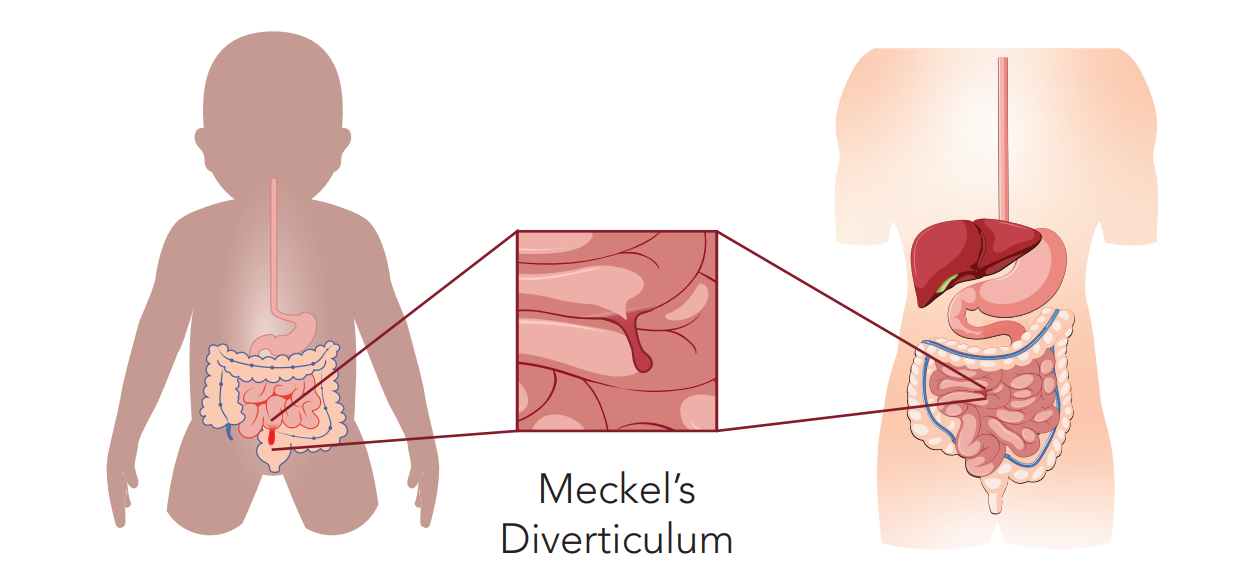 Your Meckel’s Diverticulum Scan Journey