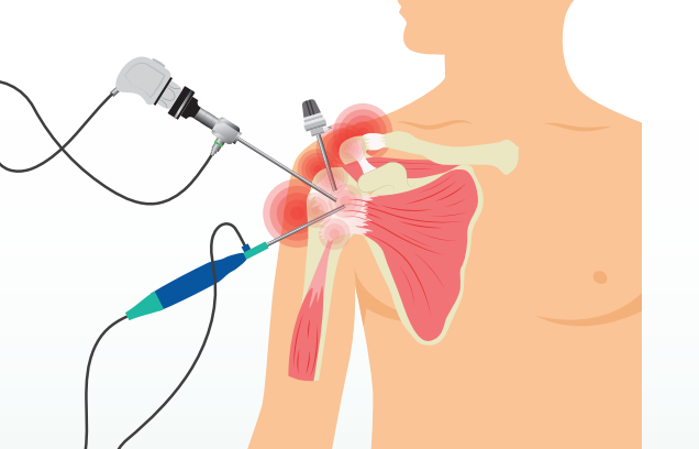 Your Arthroscopic Shoulder Rotator Cuff Repair Surgery
