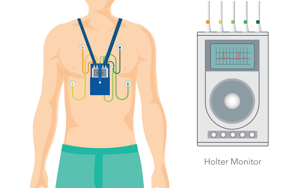 Your 48-Hour Cardiac Monitoring