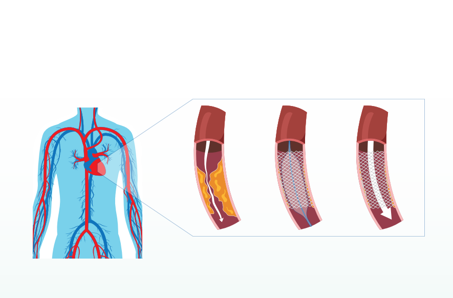 Your Coronary Angioplasty Experience