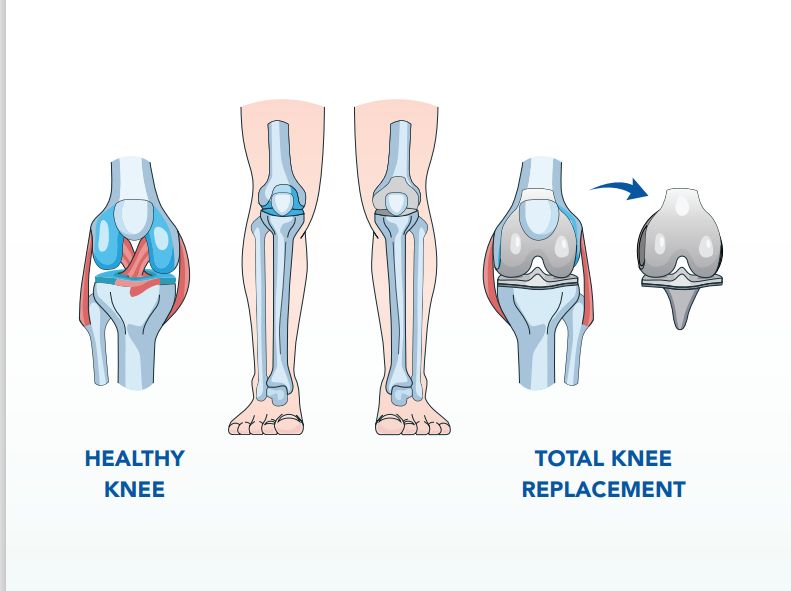 Your Knee Replacement Surgery