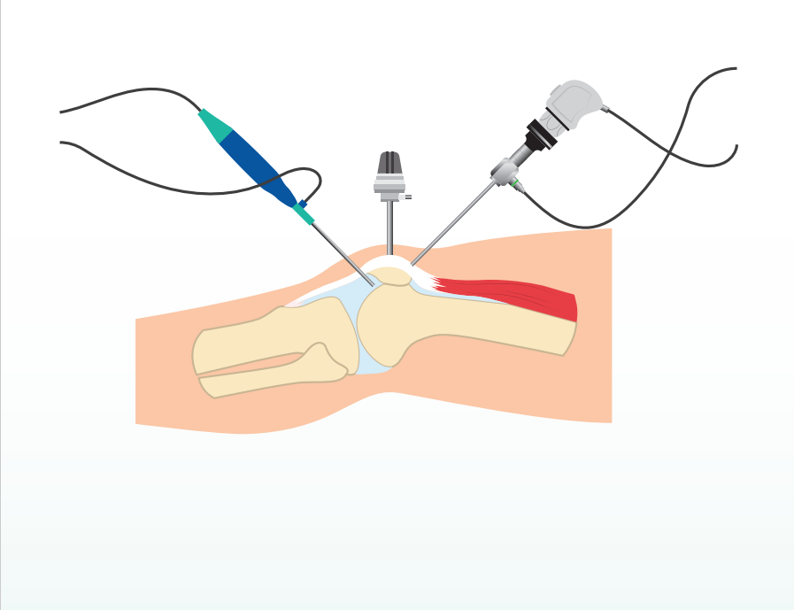 Your ACL Reconstruction Surgery Experience