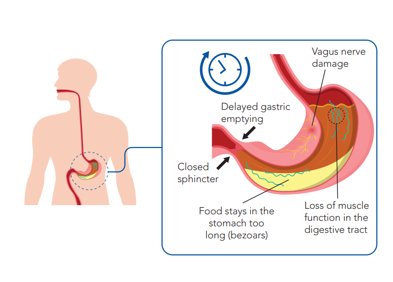 Your Gastric Emptying Scan Journey